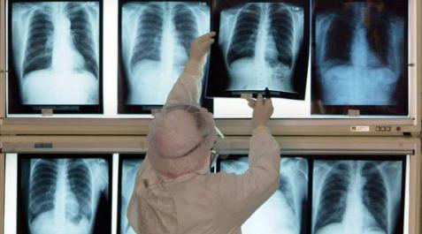 Una enfermera revisa las radiografías de pacientes afectados por neumonía. Una enfermera revisa las radiografías de pacientes afectados por neumonía.