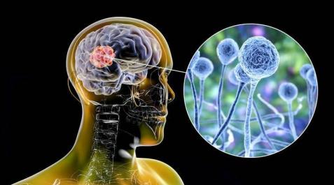 Mucormicosis o hongo negro: ¿por qué afecta a los pacientes de coronavirus? Mucormicosis o hongo negro: ¿por qué afecta a los pacientes de coronavirus?