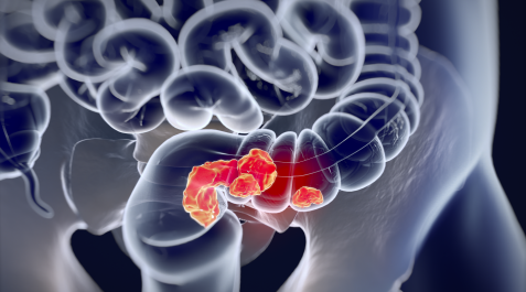 Imagen de cáncer de colon Imagen de cáncer de colon