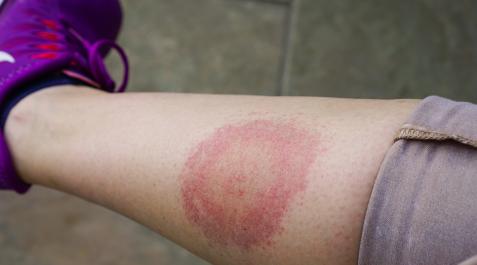 ENFEMERDAD-LYME-GARRAPATAS La enfermedad de Lyme es transmitida por la picadura de garrapatas infectadas