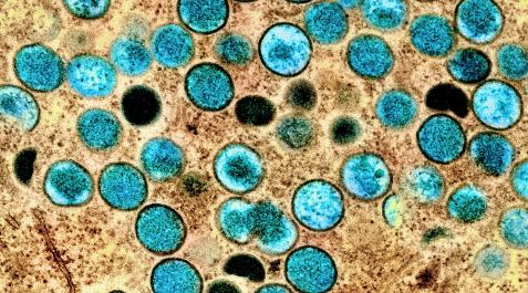 partículas de viruela del mono Imagen coloreada de partículas de viruela del mono en una célula infectada (marrón), cultivada en el laboratorio