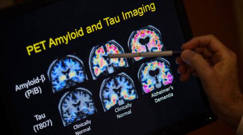 Una nueva teoría de la enfermedad de Alzheimer reevalúa el papel del beta-amiloide en el cerebro Una nueva teoría de la enfermedad de Alzheimer reevalúa el papel del beta-amiloide en el cerebro