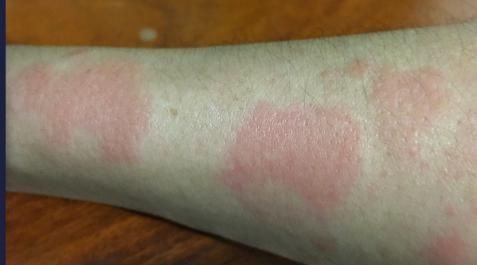 LUPUS Uno de los síntomas del lupus