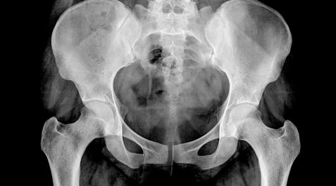 RADIOGRAFIA Una radiografía de cadera