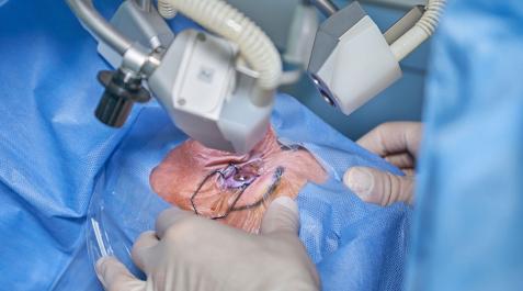 Una persona se somete a una operación de ojos Una persona se somete a una operación de ojos