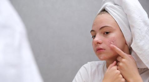 ACNE Una joven con acné