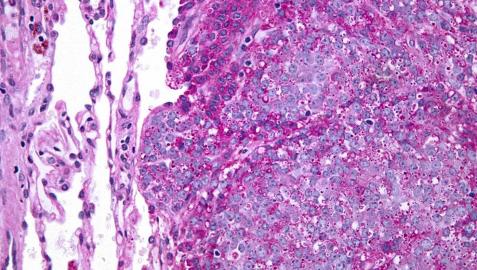 Sarcoma de Ewing: así es el tumor que padecía Álex Lequio