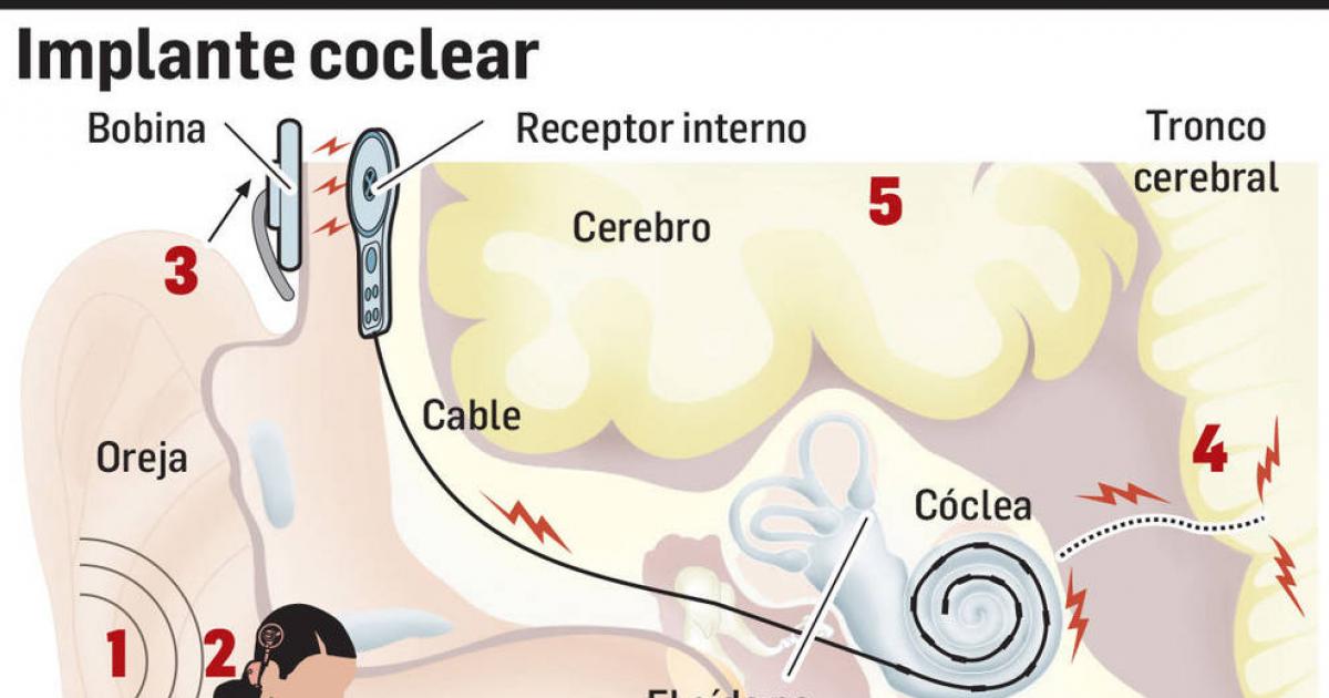 El Chn Hace Los Primeros Implantes Cocleares Del Sistema Público 3745