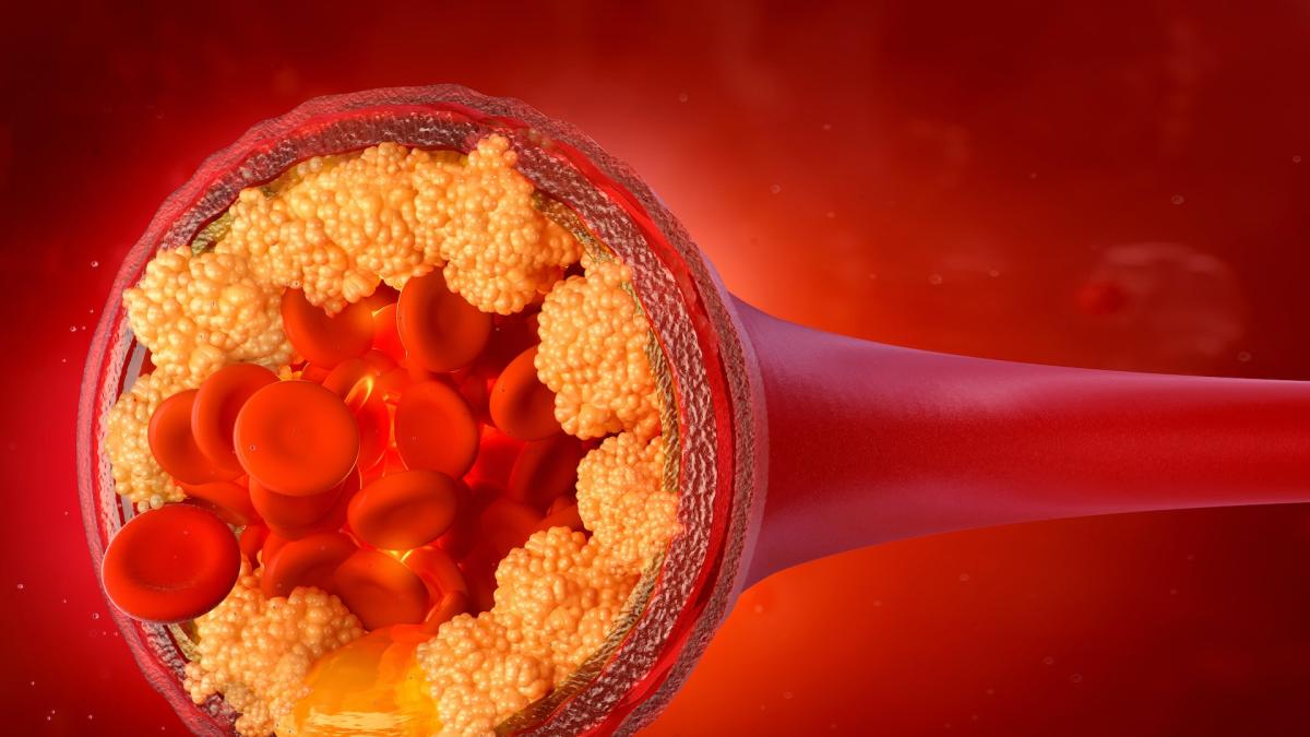 Photo: diariodenavarra.es Early Diagnosis and Treatment Vital for Familial Hypercholesterolemia, Says SEEN