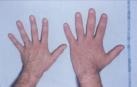 Mano con acromegalia