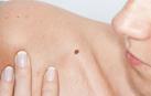 ​El melanoma avanzado, de "patito feo" a uno de los tumores con más opciones