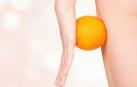 A diferencia de la celulitis producida por la acumulación de grasas (la famosa piel de naranja) hay otra que se debe a la inflamación de los tejidos conectivos celulares bajo la piel.