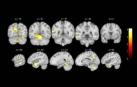 Cambios en el cerebro detectados por el estudio de la Fundación Pasqual Maragall