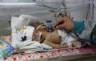Mueren por falta de atención médica dos bebés siameses yemeníes