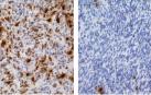 Descubren cómo algunos tumores cerebrales consiguen "esquivar" la quimioterapia