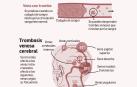 Trombos, cuando la sangre deja de circular bien