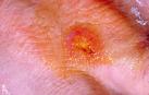 Piel afectada por tularemia