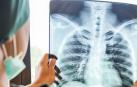 Tuberculosis