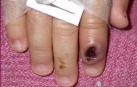 Dedo de un niño infectado por viruela del mono