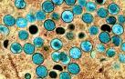 Imagen coloreada de partículas de viruela del mono en una célula infectada (marrón), cultivada en el laboratorio