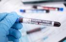 El virus de Marburgo es de la misma familia que el Ébola