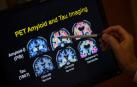 Una nueva teoría de la enfermedad de Alzheimer reevalúa el papel del beta-amiloide en el cerebro