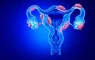 La endometriosis causa síntomas muy dolorosos