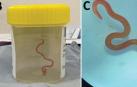 Extraen del cerebro de una australiana una lombriz intestinal viva de 8 centímetros