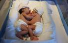 Las bebés siamesas Khadija y Cherive antes de ser operadas