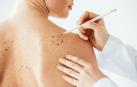 Cada año, se diagnostican en el mundo unos 325 000 nuevos casos de melanoma