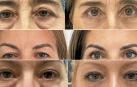 Tres ejemplos de blefaroplastia: completa (imagen superior), esta intervención incluye en una misma operación la cirugía de párpados superiores y bolsas; superior (imagen del centro), solo se interviene sobre la piel sobrante de los párpados para levantar la mirada y que los ojos no se vean encapotados; e inferior (tercera imagen), se actúa únicamente en los párpados inferiores para eliminar las bolsas