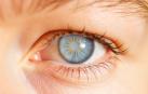 Ojo con glaucoma