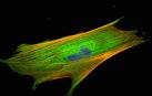 Fibroblasto asociado a cáncer